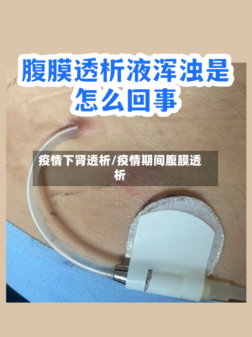 疫情下肾透析/疫情期间腹膜透析