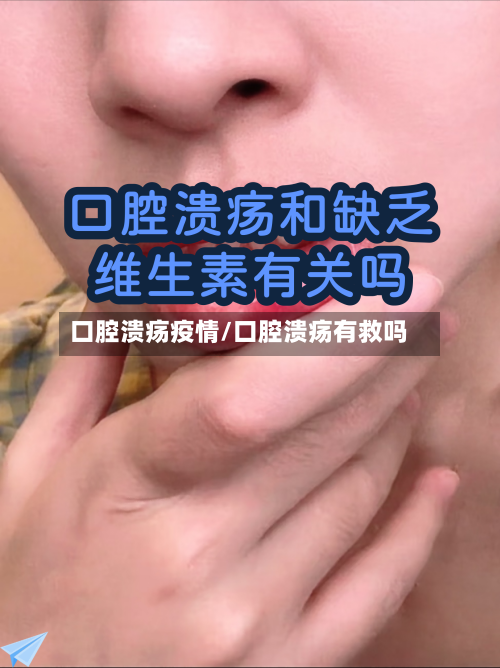 口腔溃疡疫情/口腔溃疡有救吗-第3张图片