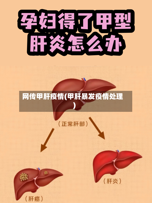 网传甲肝疫情(甲肝暴发疫情处理)-第3张图片